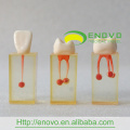 EN-N5 Enlarge Root Canal Transparent Block with Colored Pulpal Wall and Crowns